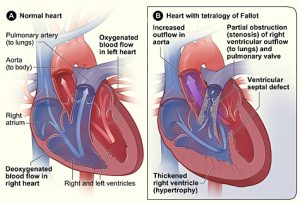 Tetralogy of Fallot a congenital defect